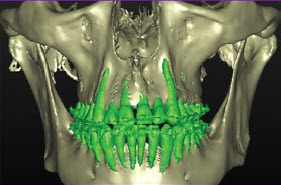 Orthodontic decompensation without SFOT