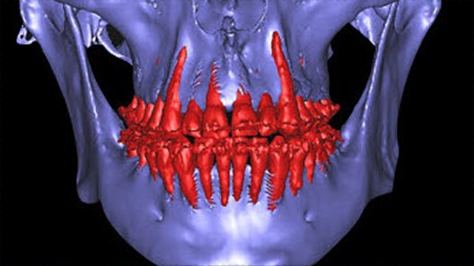 CBCT — Intervention: MARPE expansion + SFOT corticotomy