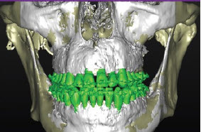 Merged CBCT post-SFOT orthodontic outcome