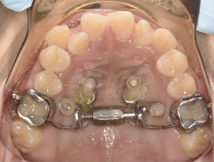 MARPE device in place
