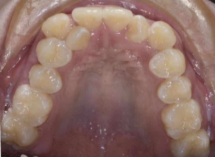 Pre-Op: Crowding and constriction