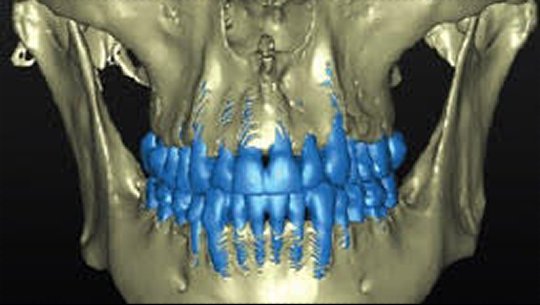 CBCT — Pre-Op: Dentoalveolar bone morphotype