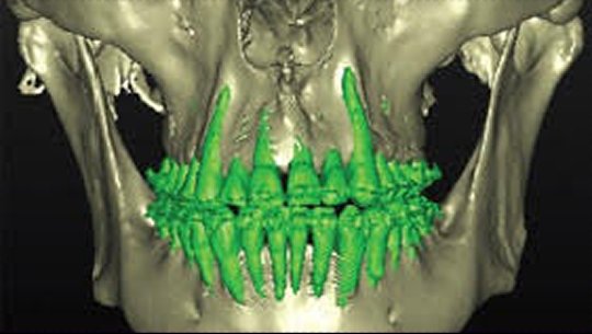 CBCT — Simulated Post-Ortho result